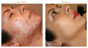 Get Effective Results For Acne Scar Treatment
