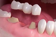 Artificial Teeth and Dental Crown Treatment Indore
