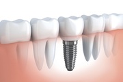 Best Dental Implants in Indore Dr Atul Jajoo