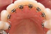 Invisible Braces for Adults and Teens in Indore